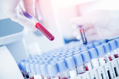 Naukowcy opracowali pierwszy test krwi pozwalający diagnozować zespół przewlekłego zmęczenia