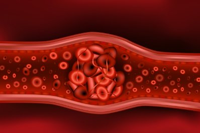 Dbamy o serce - żylna choroba zakrzepowo-zatorowa