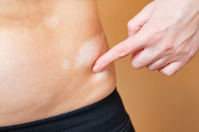 Choroby skóry a styl życia i środowisko - porady dermatologa