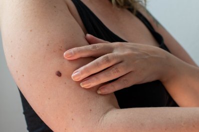 ABCDE – pięć liter, dzięki którym rozpoznasz czerniaka