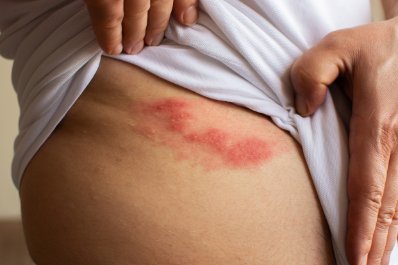 Eksperci: groźnym następstwem półpaśca jest trwająca długo neuralgia popółpaścowa