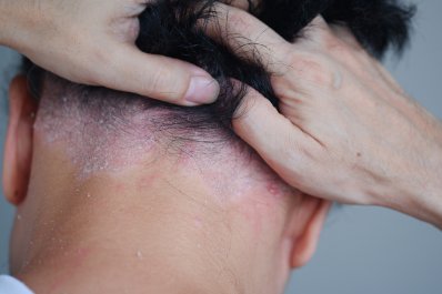 Łuszczyca - co powinien wiedzieć lekarz POZ? Diagnostyka, choroby współistniejące i nowoczesne leczenie