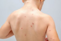 Różnicowanie najczęściej występujących chorób wysypkowych u dzieci. Kompleksowe kompendium kliniczne dla lekarzy POZ