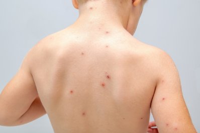 Różnicowanie najczęściej występujących chorób wysypkowych u dzieci. Kompleksowe kompendium kliniczne dla lekarzy POZ