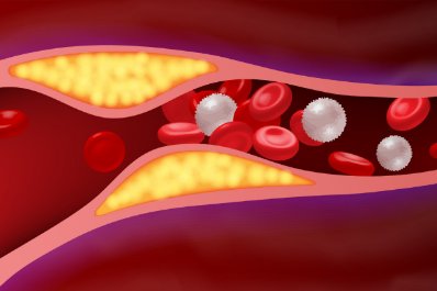 Lipoproteina(a) Express: 10 pytań, 10 odpowiedzi w 10 minut