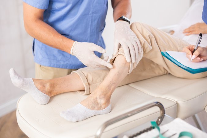 Żylaki kończyn dolnych – diagnostyka i leczenie w praktyce klinicznej