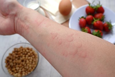 Alergie krzyżowe - na czym polega taka alergia i jak sobie pomóc?