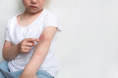 Dziecko z atopowym zapaleniem skóry - zadania pielęgnacyjno-opiekuńcze w opiece nad pacjentem