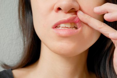 Owrzodzenia jamy ustnej – przyczyny, objawy i leczenie