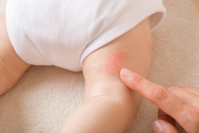 Pieluszkowe zapalenie skóry