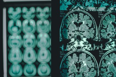 Eksperci alarmują: co trzeci Polak zachoruje na chorobę neurologiczną