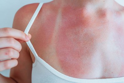 Dermatolog: czerwona skóra po opalaniu nie jest normą, to znak ostrzegawczy