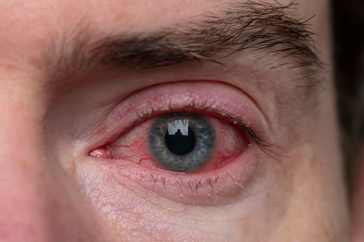 Alergiczne Choroby Oczu Publikacja Adamed Expert