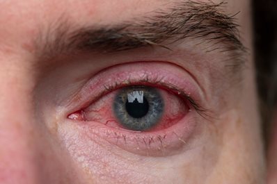 Alergiczne choroby oczu