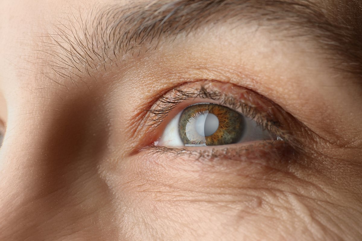 Jaskra co to za choroba? O cichym… Publikacja Adamed Expert