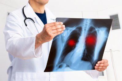 Guzki na płucach - czy muszą oznaczać nowotwór?