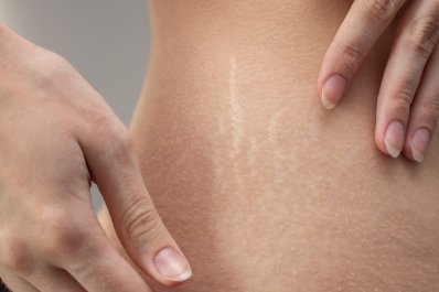 Rozstępy na pośladkach, brzuchu i nogach – domowe sposoby na usuwanie rozstępów 