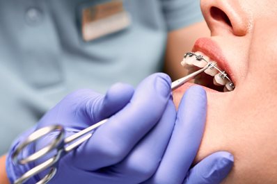 Ile trwa leczenie ortodontyczne?