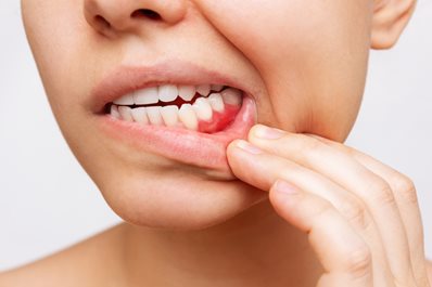 Nadwrażliwość zębów - jak leczyć?