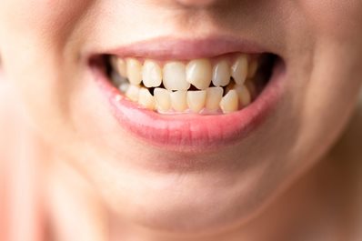 Bruksizm - zgrzytanie i ścieranie zębów